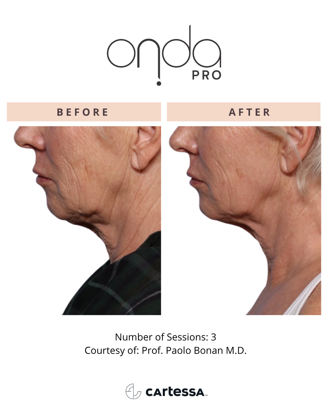 ONDA PRO chin before and after