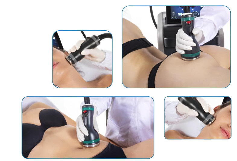 ONDA PRO treatment areas