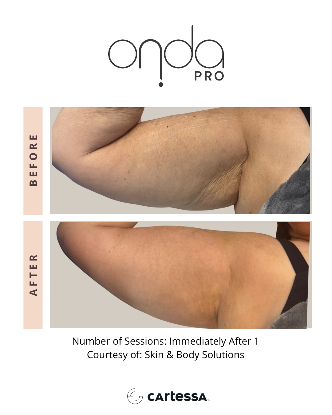 ONDA PRO underarm before and after